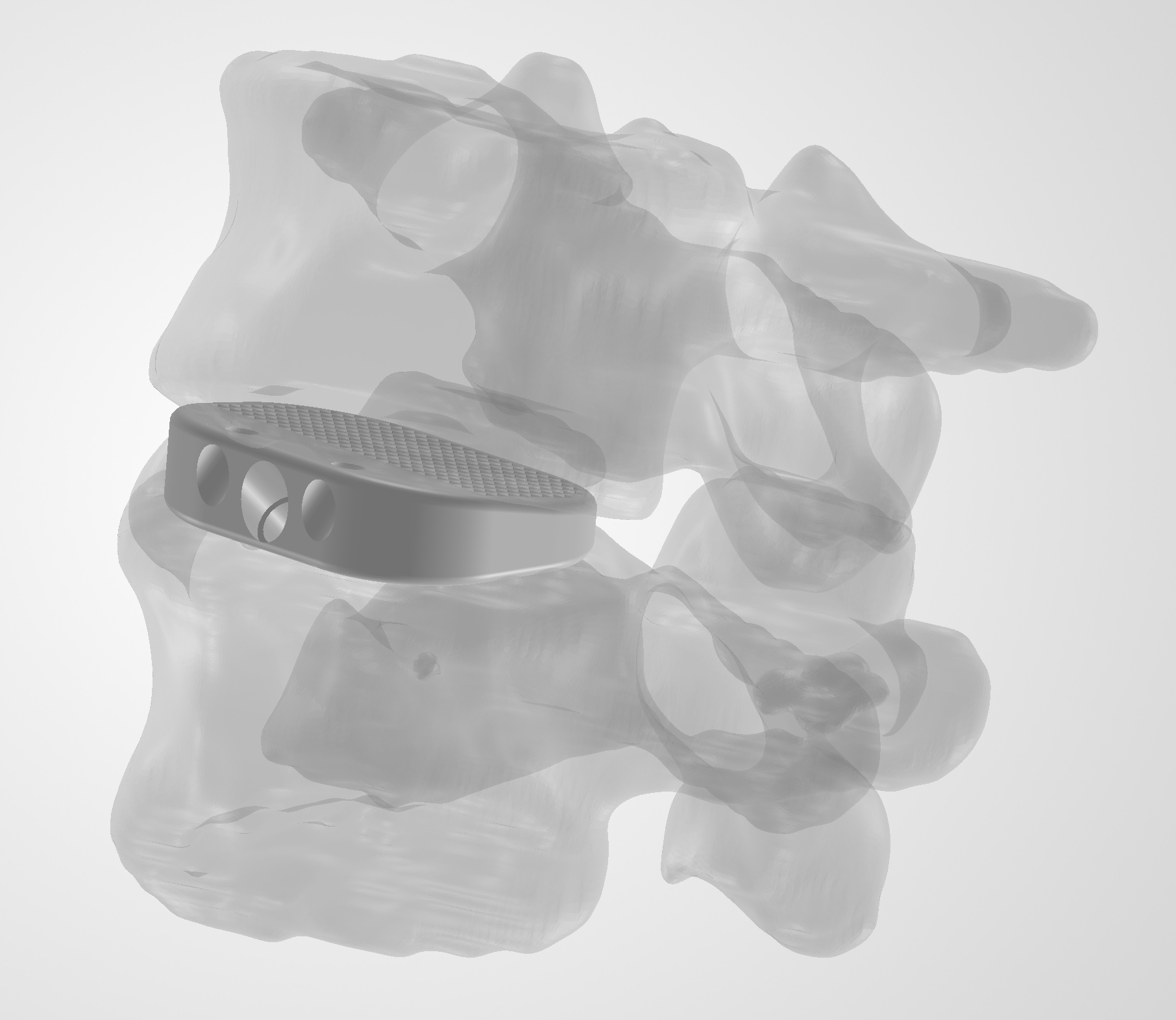 Cage with lattice inside the L4–L5 anatomy, view 1