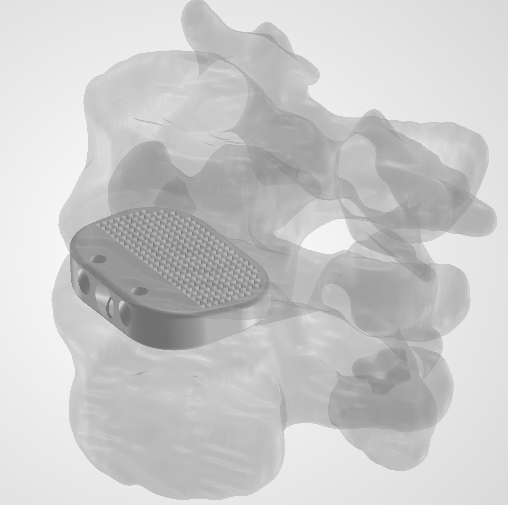 Cage with lattice inside the L4–L5 anatomy, view 2