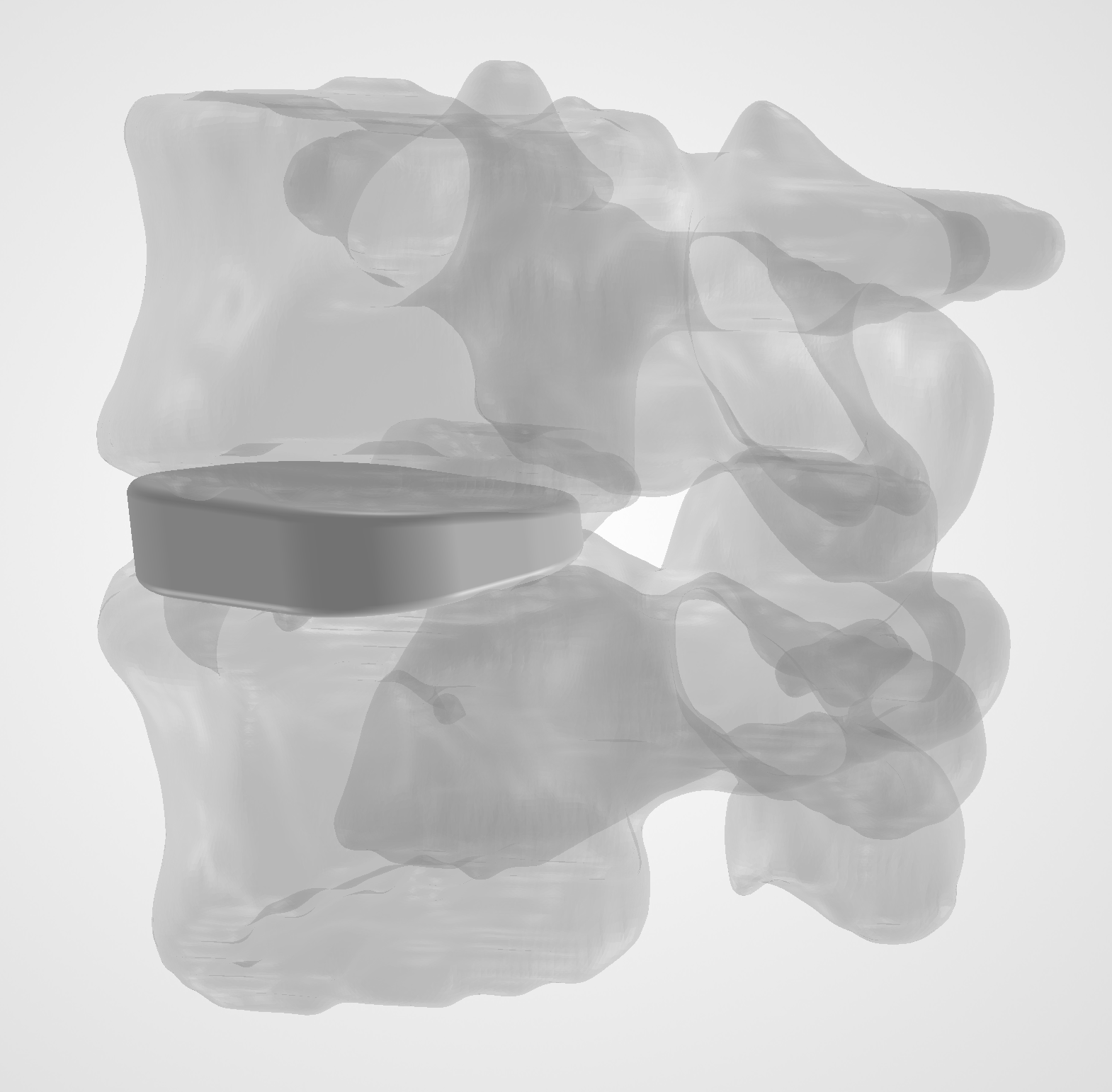 Cage positioned within the L4–L5 anatomy, view 1
