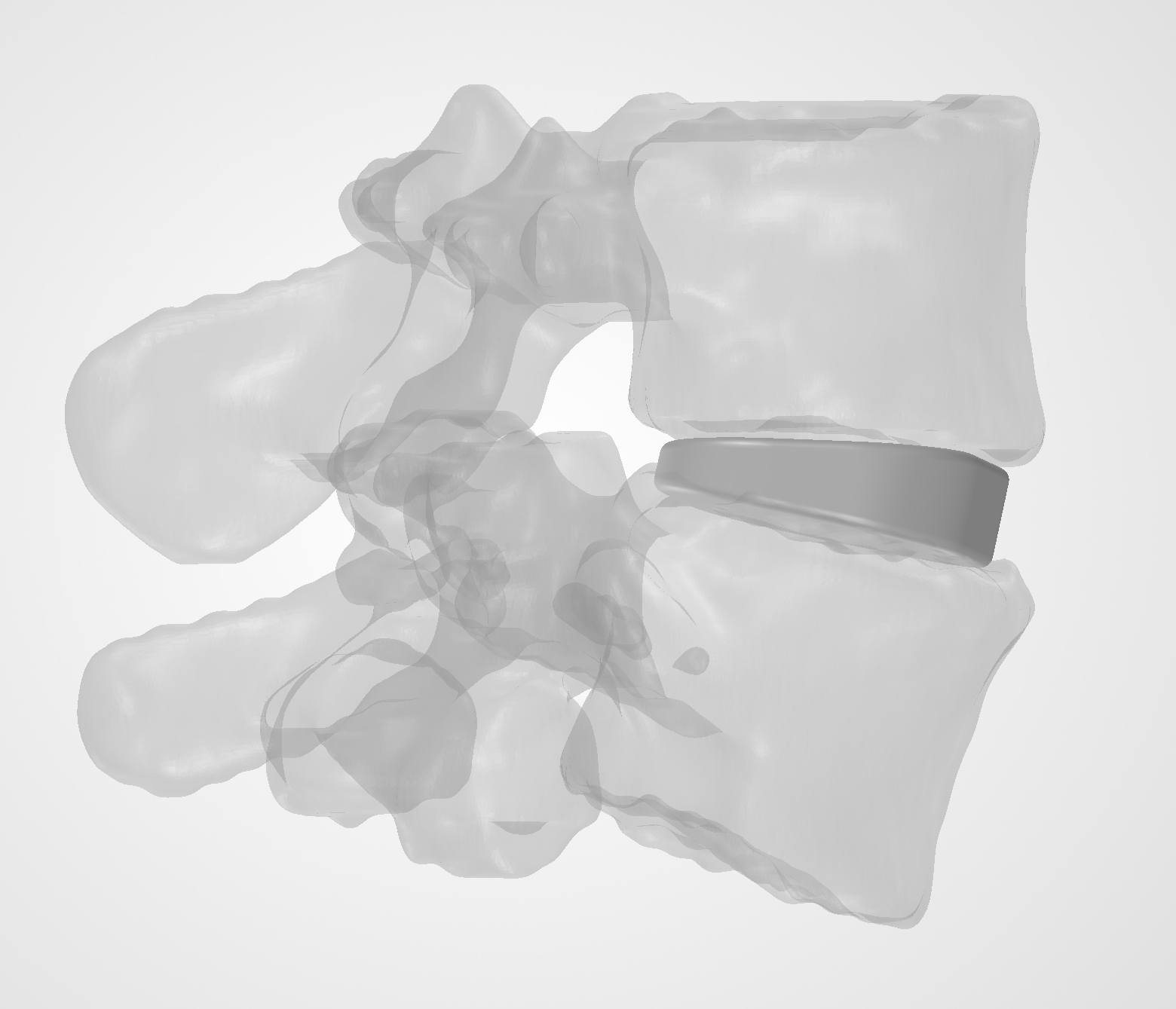 Cage positioned within the L4–L5 anatomy, view 2