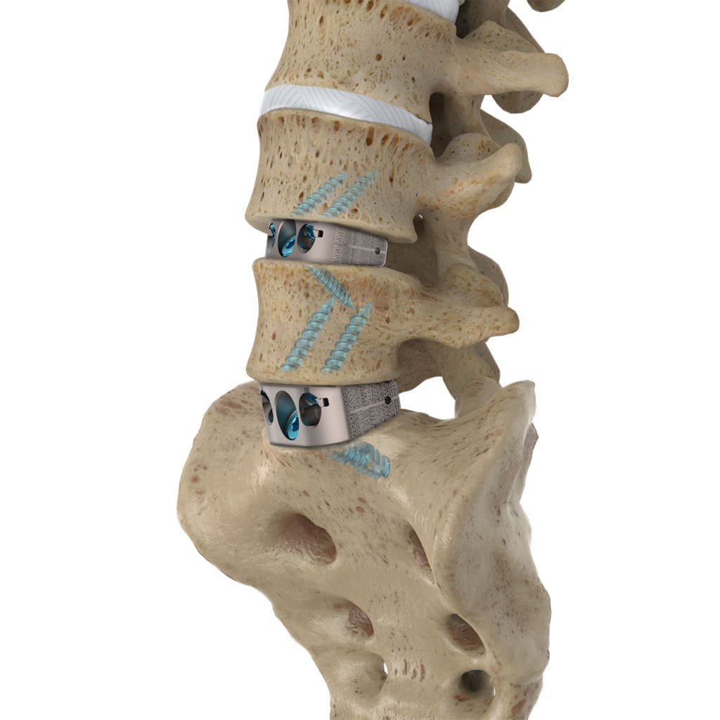Reference image of commercial spinal fusion cages