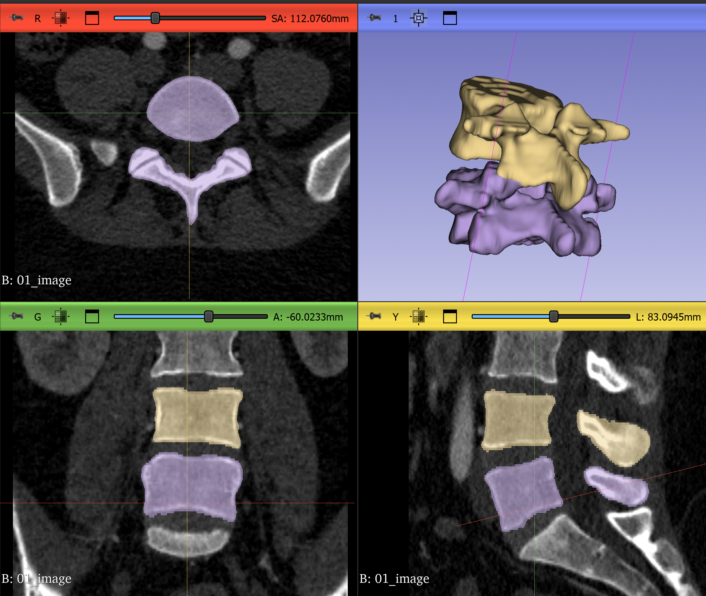 Revised segmentation with measurements, view 1