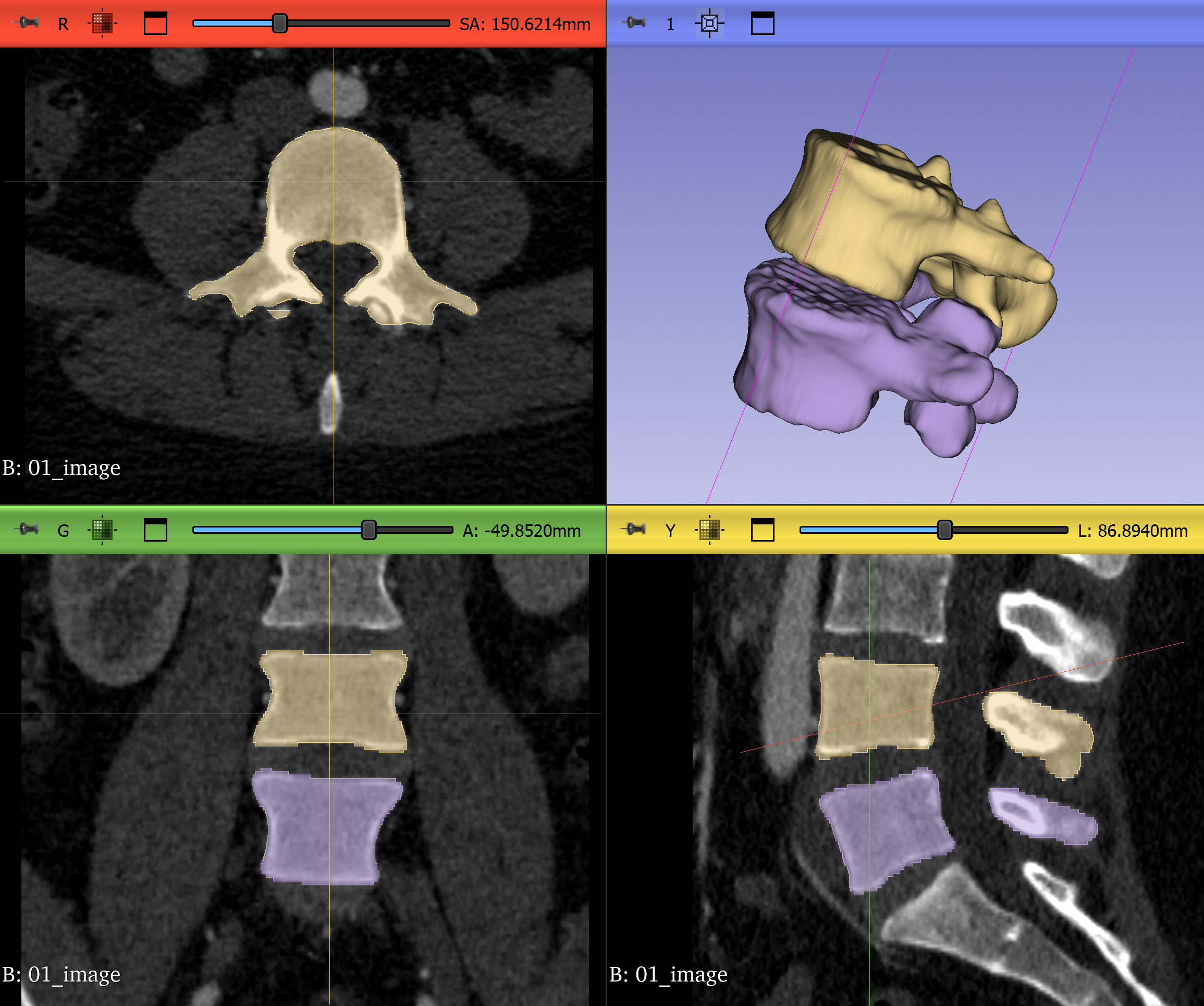 Revised segmentation with measurements, view 2