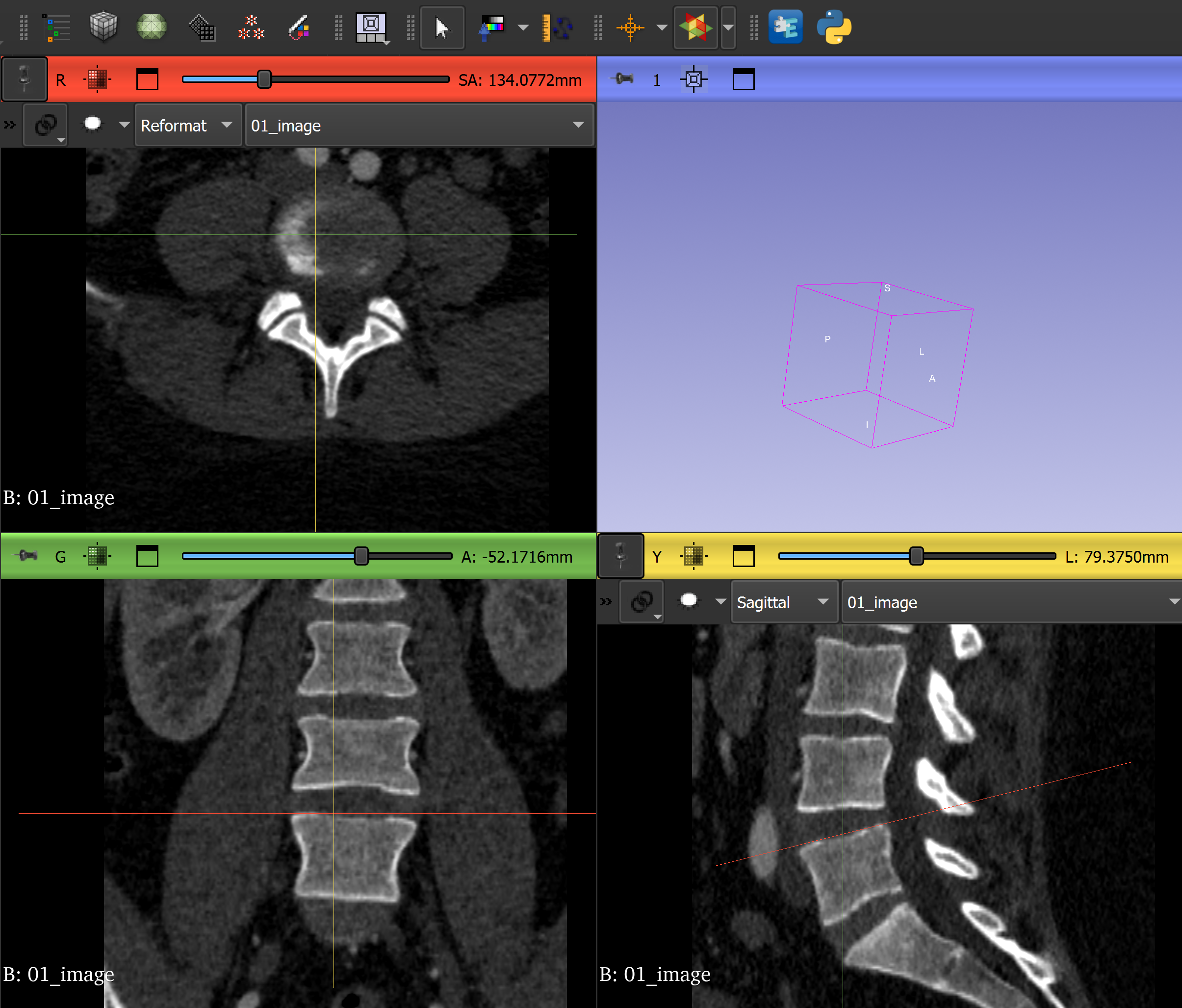 Lumbar CT dataset loaded in 3D Slicer
