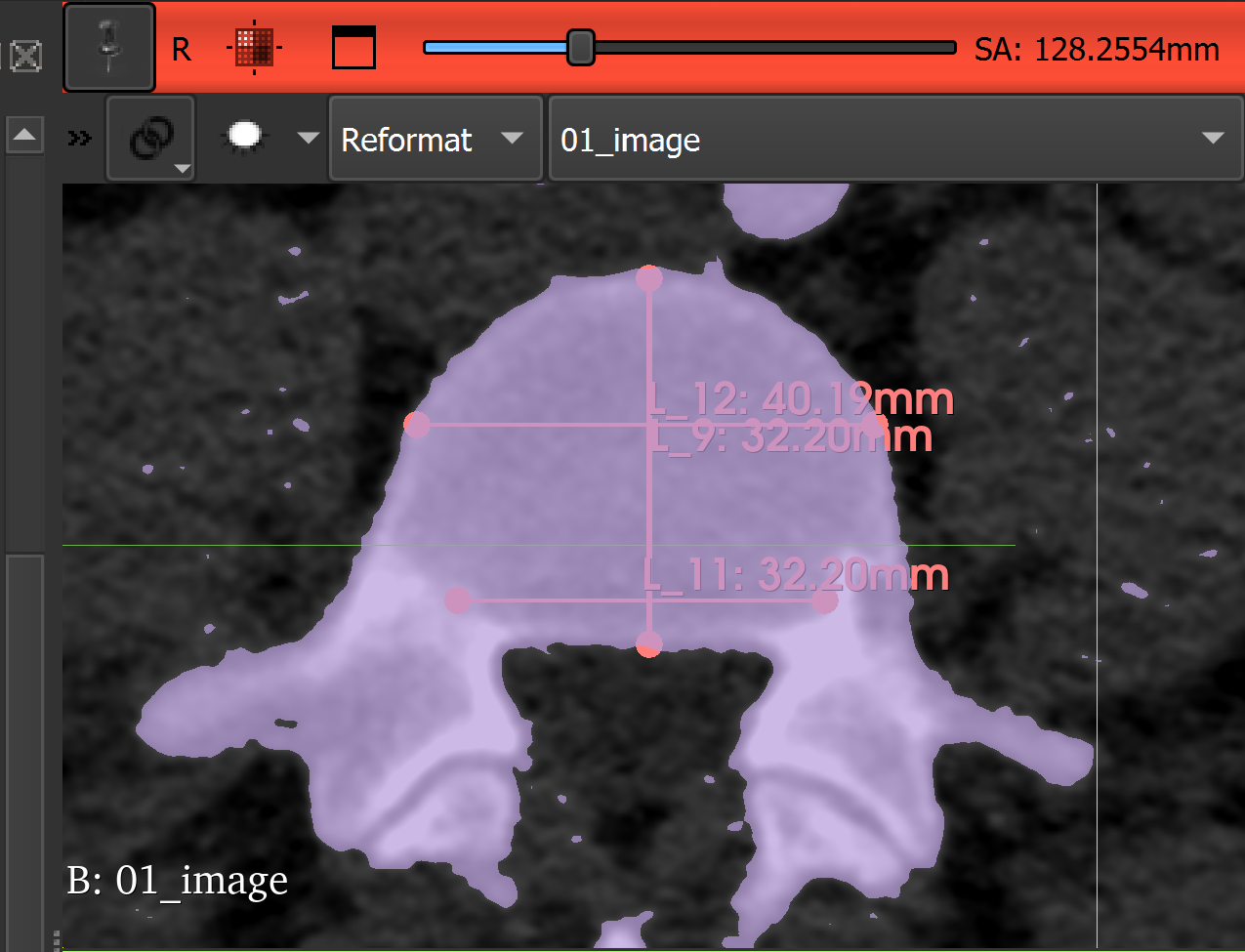 L4 and L5 segmentations in 3D Slicer